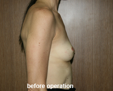 plastic-surgery-breast-augmentation